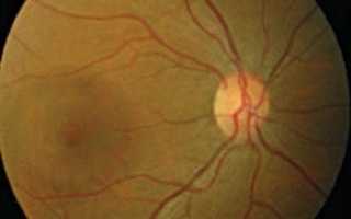 Диагностика и лечение разных форм хориоретинита глаза