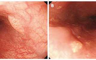 Лечение плоскоклеточной папилломы пищевода