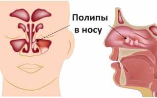 Насморк и чихание без температуры у взрослого – как лечить и что делать