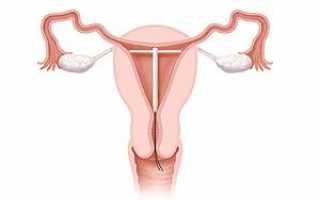Можно ли ставить спираль женщинам после кесарева сечения