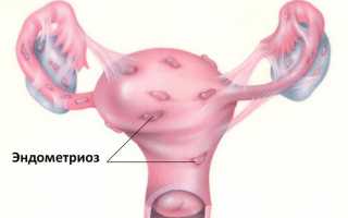 Эндометриоз после родов — особенности течения и лечения заболевания
