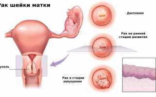 ВПЧ 18 типа: симптомы и лечение