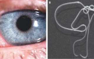 Симптомы и лечение дирофиляриоза глаз у человека