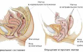 Симптоматика опущения матки после родов