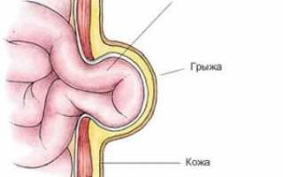 Основные причины развития пупочной грыжи у женщин после родов