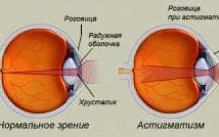 Сложный миопический астигматизм – близорукий левого глаза