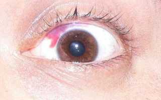 Глазные капли от сварки – глаза болят: что делать, как вылечить