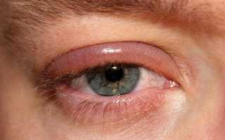 Капли Сульфацил натрия – инструкция по применению в глаза
