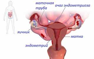 Успешная беременность при хроническом эндометрите – мнение специалистов