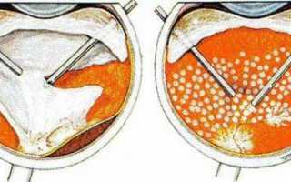 Отслоение сетчатки глаза – лечение народными средствами