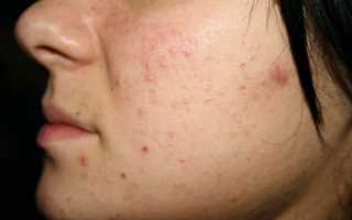 Избавление от гельминтоза позволяет справиться с кожными высыпаниями