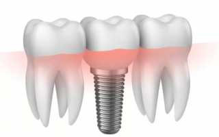 Как правильно выбрать способ протезирования