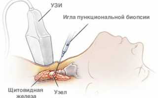 Биопсия щитовидной железы: необходимость, процедура и результаты