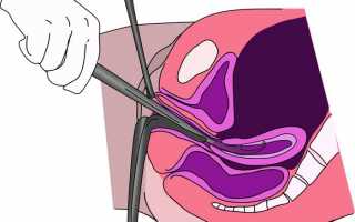 Чистка матки после родов: главные последствия для женщины