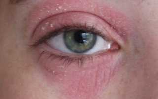 Псориаз на глазах: симптомы заболевания
