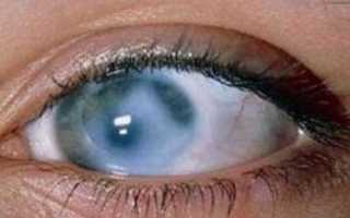 Что такое глаукома, каковы ее причины и последствия?