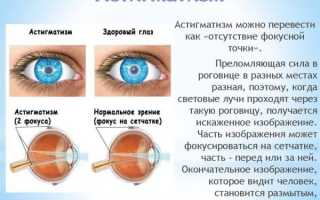 Что такое астигматизм глаз – причины и лечение, как вылечить заболевание