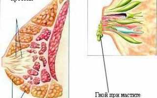 Симптомы мастита у кормящей матери и правильное лечение