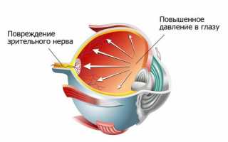 Признаки глазного давления и симптомы – как проявляется, чем лечить