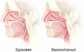 Вазомоторный ринит: причины, симптомы и лечение