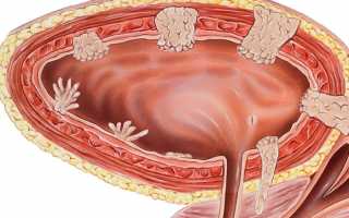 Папиллома мочевого пузыря: медицинское и народное лечение
