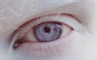 Светобоязнь у ребенка – при каких заболеваниях глаз: причины и симптомы