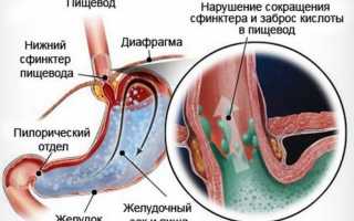 Першит в горле и кашель: причины, лечение