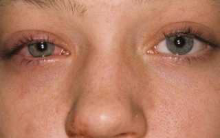 Как распознать и вылечить аллергию вокруг глаз