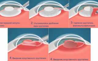 Сколько длится операция по удалению катаракты – как делают замену хрусталика