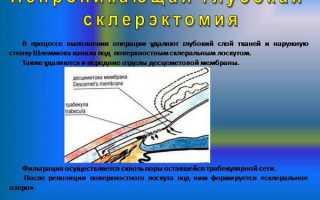 Лазерное лечение глаукомы – плюсы и минусы операции лазером