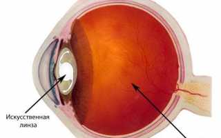 Артифакия – мкб-10 код: как лечить артификацию глаза у взрослых