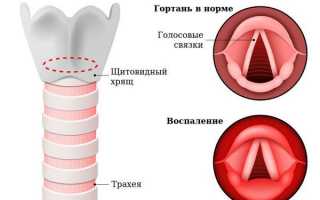 Острый ларингит: причины, симптомы и лечение