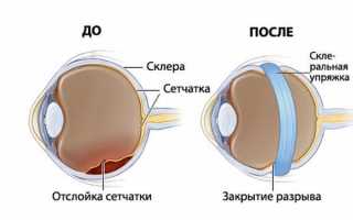 Отслойка сетчатки глаза – симптомы, причины и лечение