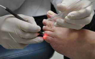 Правила лечения грибка ногтей лазером
