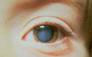 Причины, симптомы глаукомы, методы ее лечения и профилактики