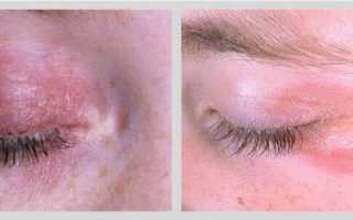 Грибок глаз: фото симптомов, эффективное лечение
