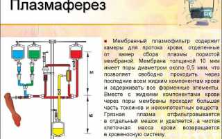 Плазмаферез при псориазе: особенности процедуры, показания и противопоказания