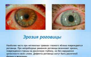 Травматическая эрозия роговицы глаза – лечение рецидивирующей