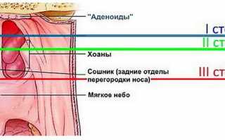 Физиологический ринит у ребёнка: причины, симптомы и лечение насморка